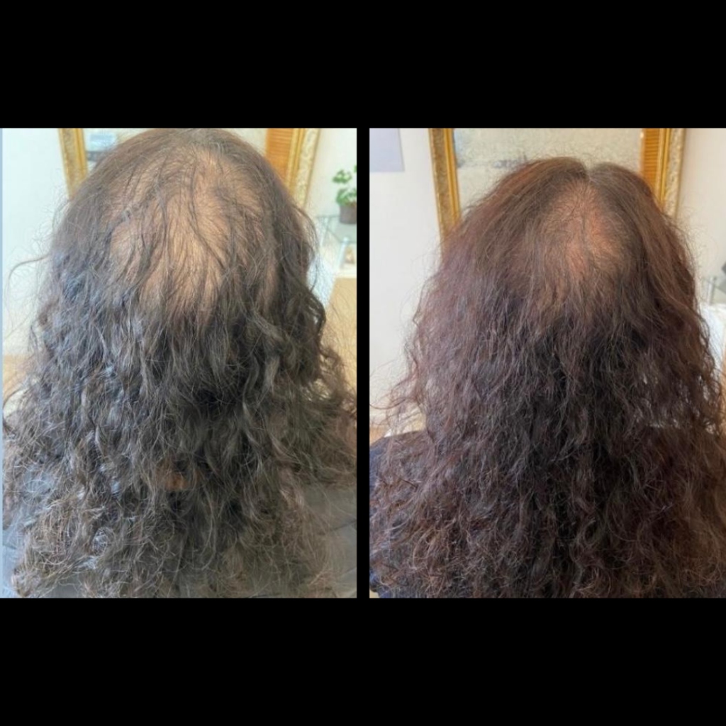 Antes e depois queda capilar 3